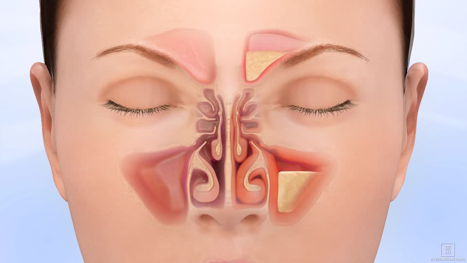 5 Jenis Penyakit yang Sering Menyerang Rongga Hidung