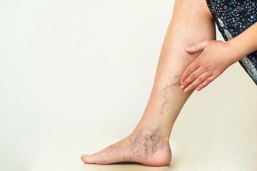 10 Tips to Prevent Varicose Veins in the Legs Early